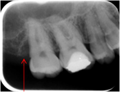 歯周組織再生療法1