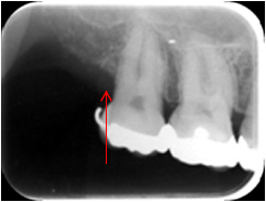 歯周組織再生療法2