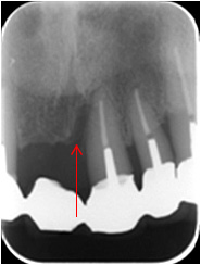 歯周組織再生療法3