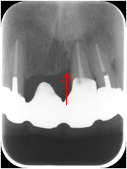 歯周組織再生療法4
