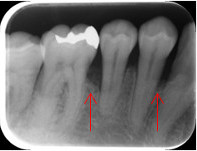 歯周組織再生療法5
