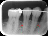 歯周組織再生療法6
