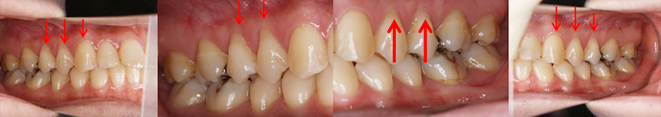 根面被覆（結合組織移植術）歯肉退縮、歯肉の厚さの改善