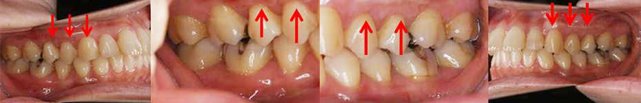 根面被覆（結合組織移植術）歯肉退縮、歯肉の厚さの改善