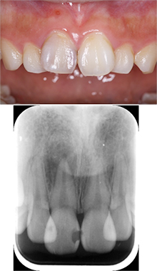 審美歯科治療と根管治療を行った例
