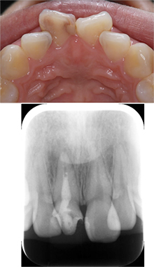 審美歯科治療と根管治療を行った例