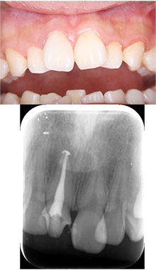 審美歯科治療と根管治療を行った例