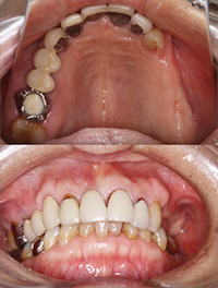 義歯を含めた総合治療