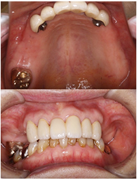 義歯を含めた総合治療