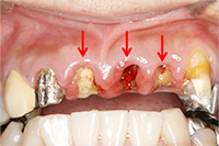 歯肉縁下の虫歯治療（挺出+歯周外科）