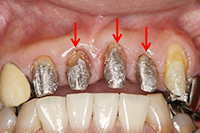 歯肉縁下の虫歯治療（挺出+歯周外科）