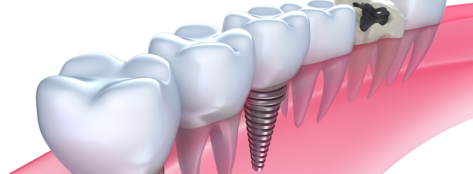 他の歯を守るインプラント治療