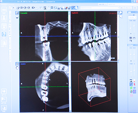 歯科用CTによる正確な診査診断